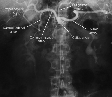 interventional [Nicks Radiology Wiki]