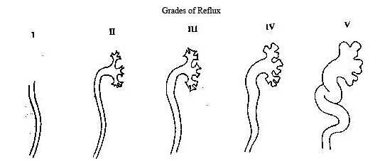 Grades of Vesicoureteral Reflux