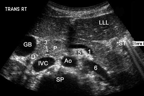 Legend:
  * 1 = splenic vein
  * 2 = gastroduodenal artery
  * 3 = common bile duct
  * GB = gallbladder
  * P = pancreatic head
  * SP = spine
  * ST = stomach
  * U = uncinate process
  * 4 = superior mesenteric vein (SMV)
  * 5 = superior mesenteric artery (SMA)
  * 6 = left renal vein
  * Ao = aorta
  * D = duodenum
  * IVC = inferior vena cava
  * LLL = left lobe of the liver