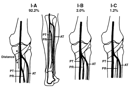 Anatomy of the Trifurcation
AT = Anterior Tibial Artery
PT = Posterior Tibial Artery
PR = Fibular or Peroneal Artery