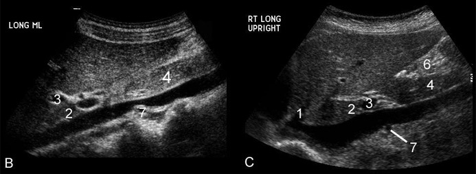 ultrasound [Nicks Radiology Wiki]