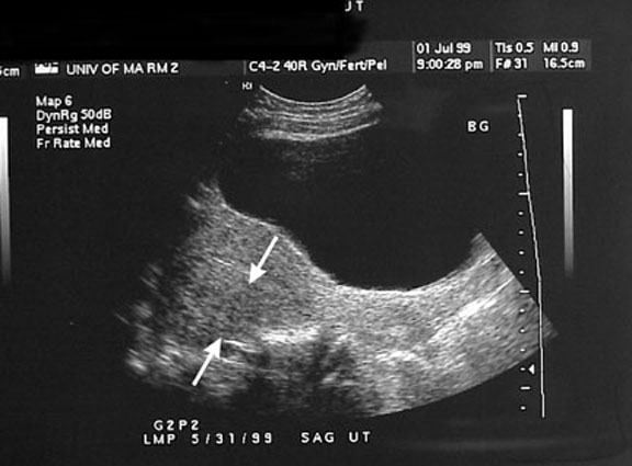 Sagittal magnetic resonance image of an enlarged uterus with a thickened posterior myometrium. T2-weighted image without gadolinium enhancement shows a widened junctional zone of 23 mm (arrows) and focal high signal intensity (arrowheads).